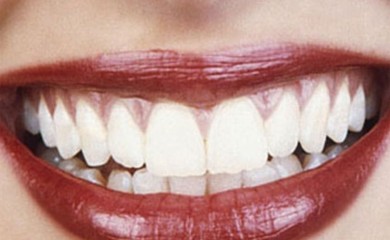 Stomatolozi preporučuju da unos ovih namirnice smanjite na minimum