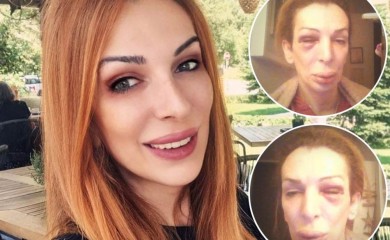 "PRETUKLI SU ME DRUGOVI KRISTIJANA GOLUBOVIĆA" - Nataša u modricama i BOLOVIMA: Udarali su me, vukli i slomili telefon!