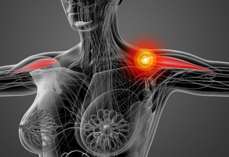 Dezmoidni tumori – gdje se razvijaju i po čemu se prepoznaju