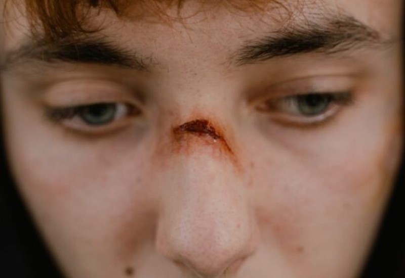 Evo zašto ranu ne treba ispirati ALKOHOLOM, cijeli život pravimo ovu GREŠKU