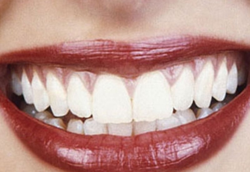 Stomatolozi preporučuju da unos ovih namirnice smanjite na minimum