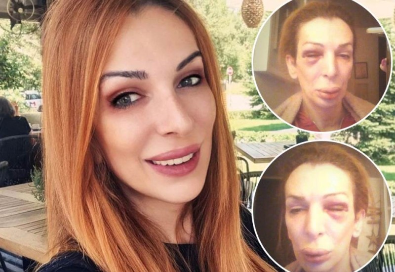 "PRETUKLI SU ME DRUGOVI KRISTIJANA GOLUBOVIĆA" - Nataša u modricama i BOLOVIMA: Udarali su me, vukli i slomili telefon!