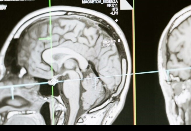 Zapanjujuća otkrića: Naučnici snimili šta se dešava u mozgu osobe na samrti